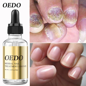 OEDO Травяная Питательная жидкость для ухода за ногтями, Отбеливающая ногти, Удаляющая инфекцию, Улучшающая загрубение ногтей, Восстанавливающая блеск ногтей, Лак для ногтей